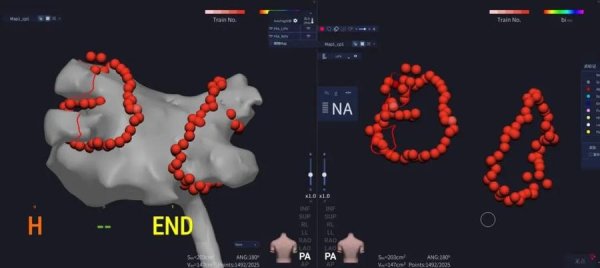 大牛配资 滕州市中心人民医院心血管内科成功开展心房颤动脉冲消融术